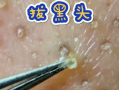 挤粉刺视频,告别痘痘困扰！