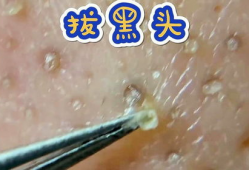 挤粉刺视频,告别痘痘困扰！